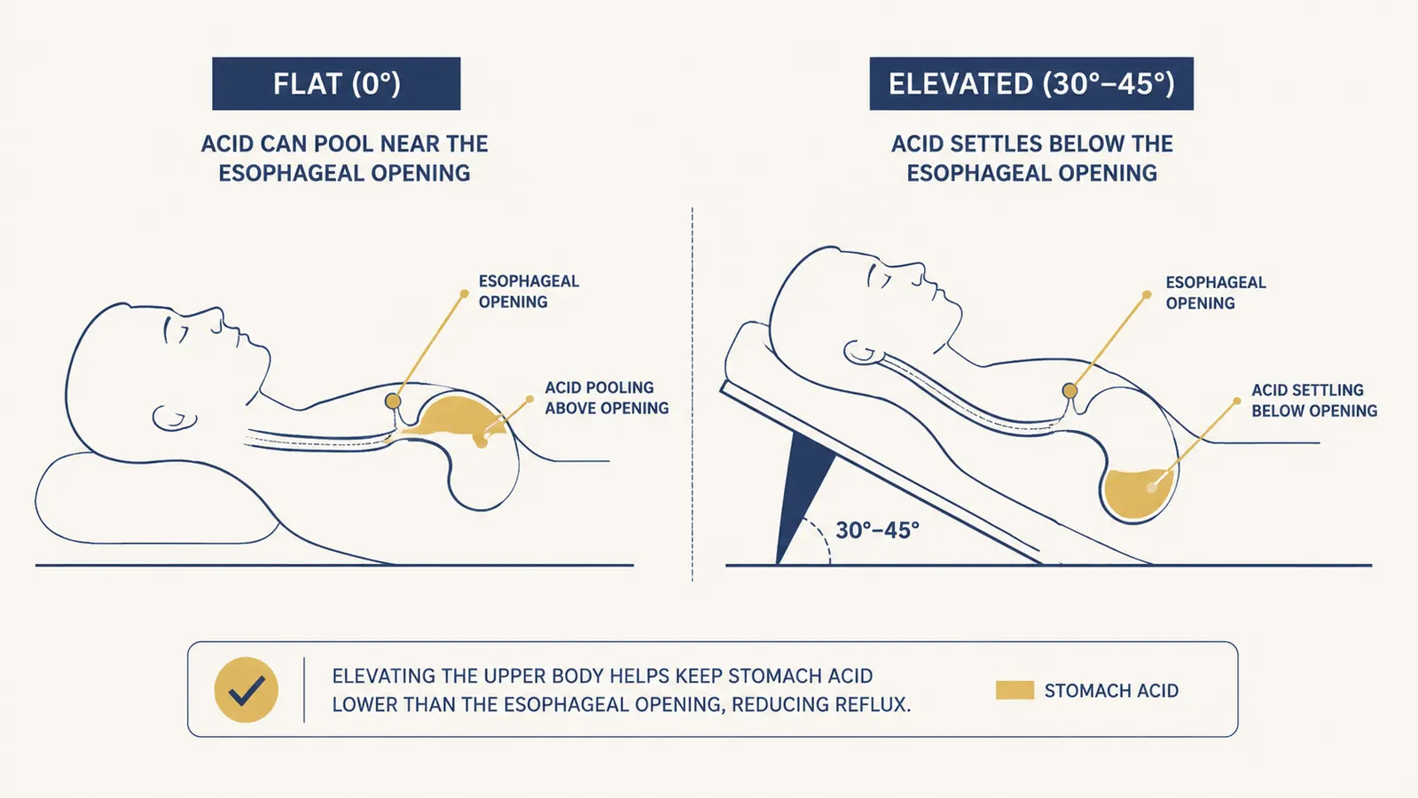 Simple chart showing stomach acid position relative to the esophagus when flat versus elevated at 30 to 45 degrees